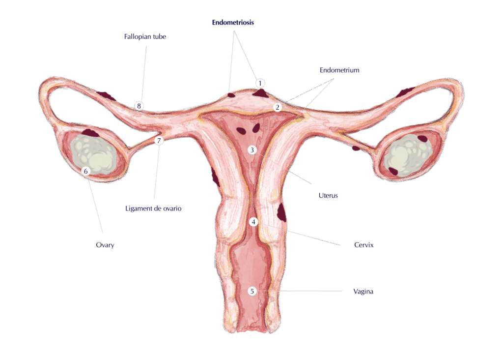 best gynecologist for endometriosis near Andheri West