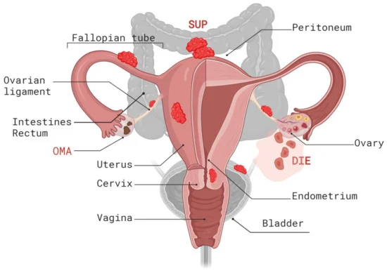 best gynecologist for endometriosis in Andheri West